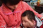 4岁女童患眼癌肿瘤似碗